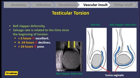 test for testicular torsion ultrasound|testicular torsion treatment guidelines.